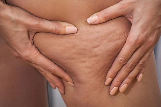 Celulitis y piel irregular: lo que debes saber